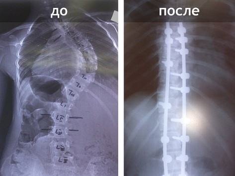 Кировские врачи провели уникальную операцию на позвоночнике