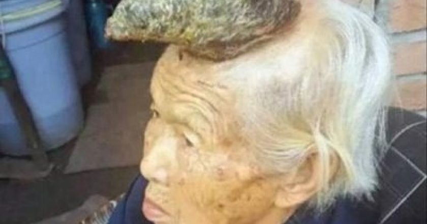В Китае на голове у 87-летней женщины вырос 13-сантиметровый рог