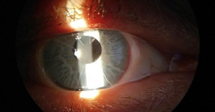 В Кирове 53-летнему мужчине впервые поставили имплант радужки глаза